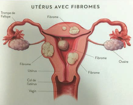 Magazine Le Patient - Les Fibromes Utérins