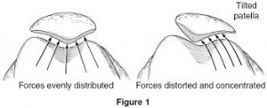 Figure 2. Mal alignement patellaire (1)